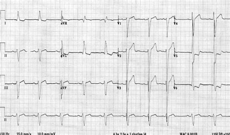 criteria for lvh litfl.